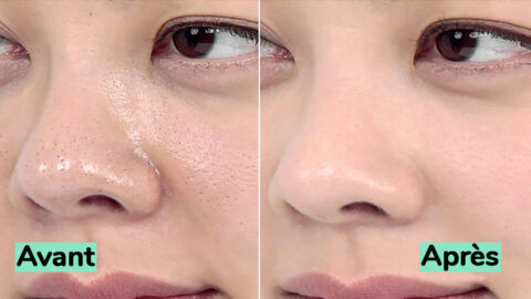 5 remèdes maison pour se débarrasser des pores obstrués
